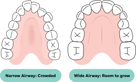 A narrow dental arch beside a wide dental arch